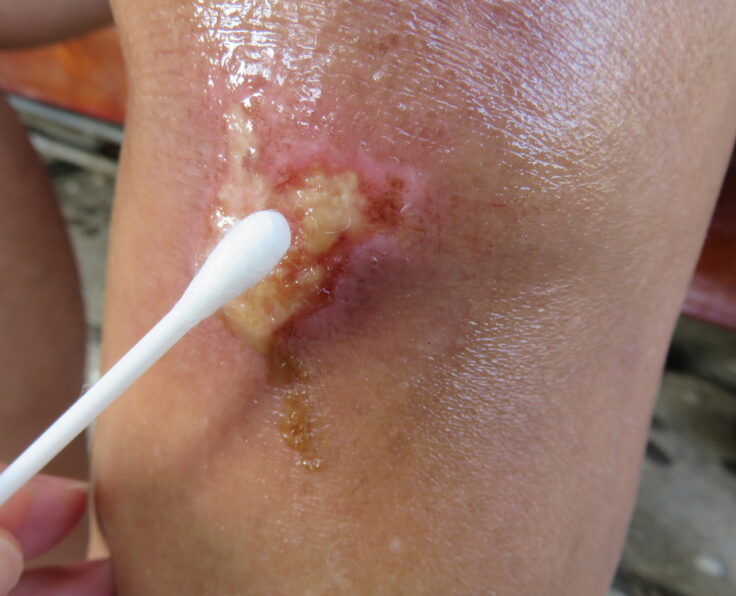 Using,Cotton,Swab,To,Clean,Pyogenic,Granuloma,Or,Infected,Wound