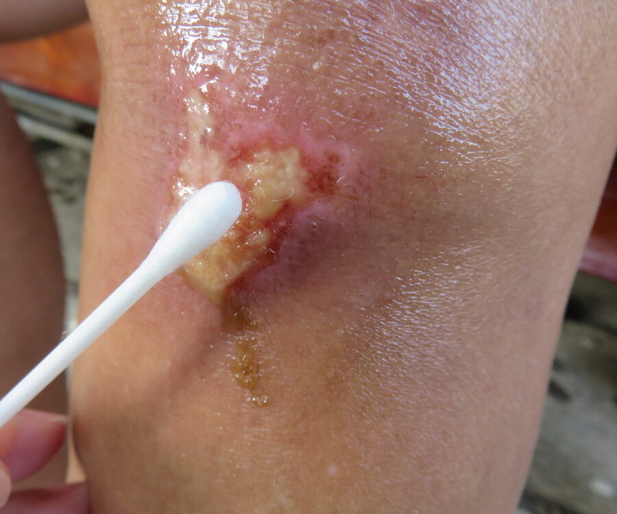 Using,Cotton,Swab,To,Clean,Pyogenic,Granuloma,Or,Infected,Wound