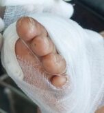 Diabetic Foot Wound in St Augustine