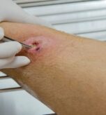 Infected Cut