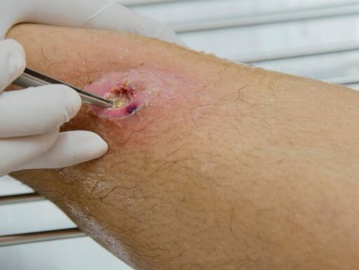 Infected Cut