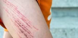 Minor Scrapes and cuts in St Augustine
