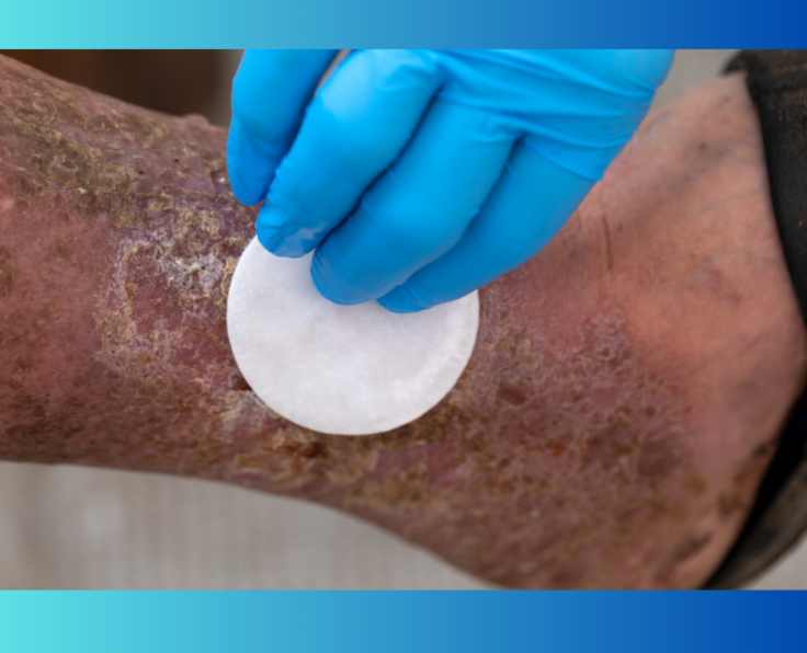 Wound Debridement St Augustine