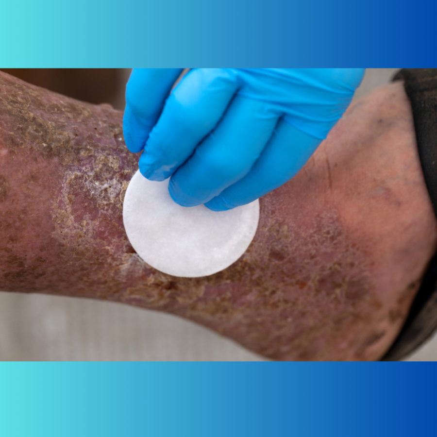 Wound Debridement St Augustine